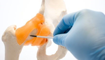 שחיקת סחוס - תמונת המחשה